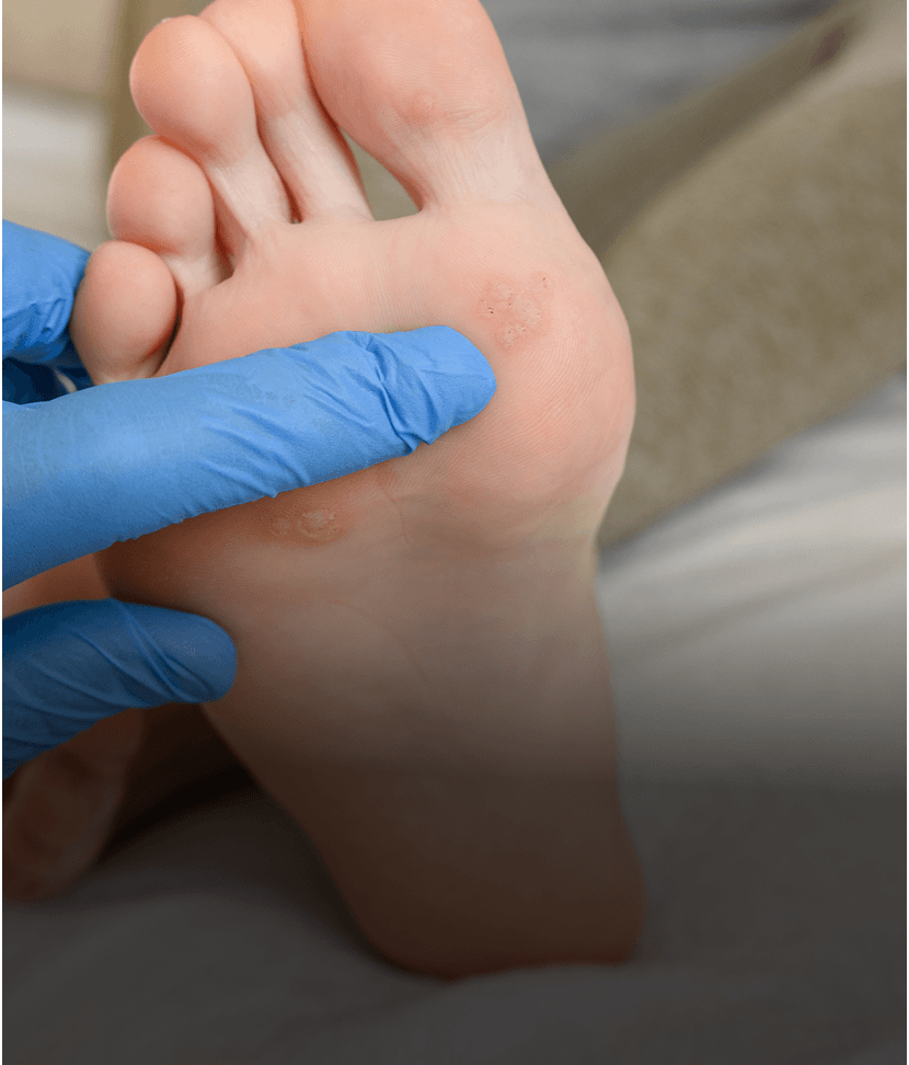 Gloved hand examining foot for warts.