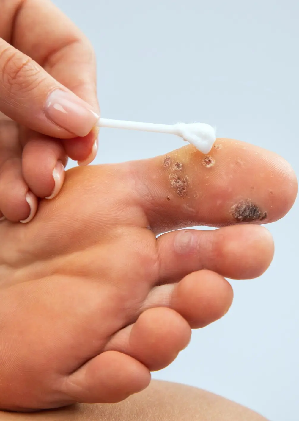 Treating foot warts with cotton swab.